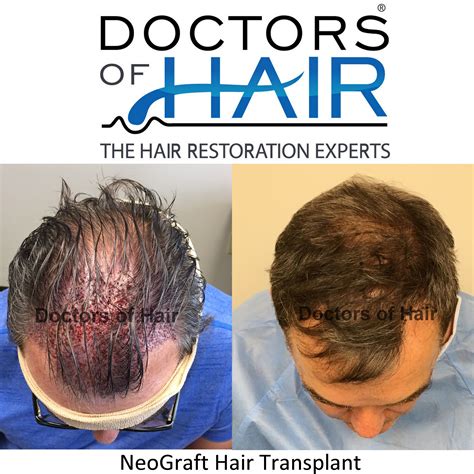 best hair restoration clinic st louis|Neograft Hair Transplant Clinic .